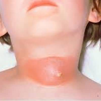 deep neck infections